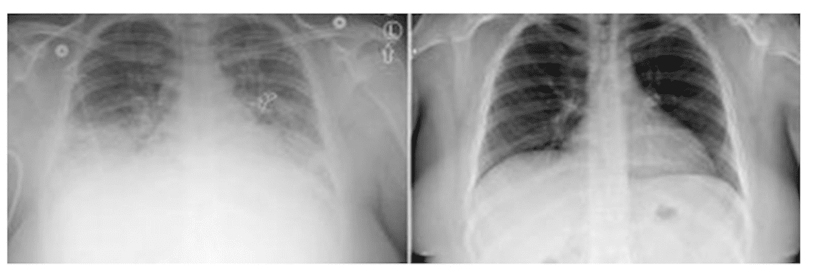 VAPI-Lungs-Before-and-After-Treatment-courtesy-U-Utah.png