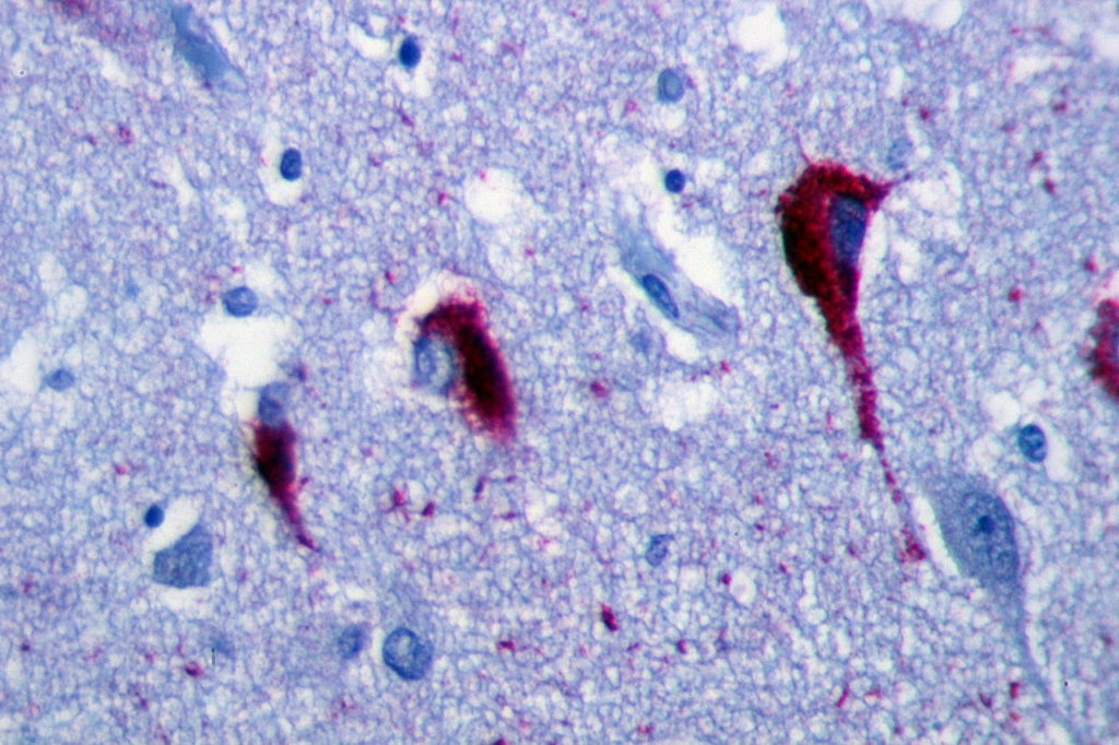 1280px-Neurofibrillary_tangles_in_the_Hippocampus_of_an_old_person_with_Alzheimer-related_pathology_immunohistochemistry_for_tau_protein-1024x682.jpg