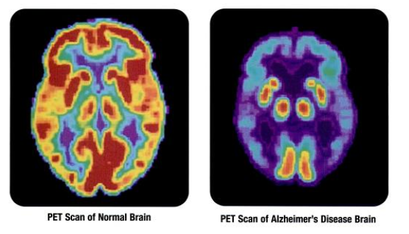 PET_scan-normal_brain-alzheimers_disease_brain.png