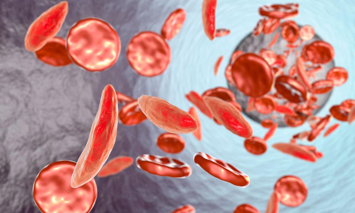 sickle-cell-anemia-and-medical-marijuana.jpg