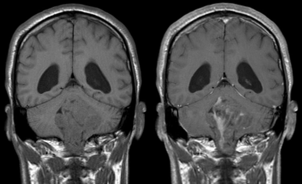 brain-tumor-mri.jpg
